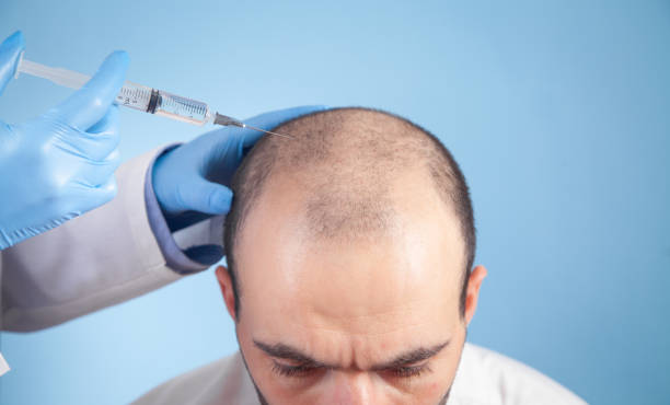 Transplante de cabelo preço